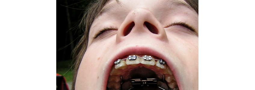 Malokluzyon Nedir, Ortodontik Sorunların Sınıflandırılması