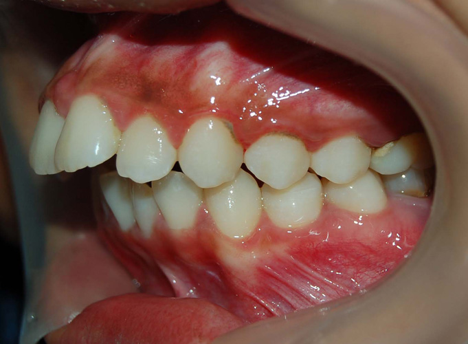 ortodontik-sorunlarin-siniflandirilmasi-2