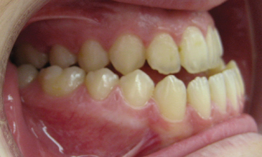 ortodontik-sorunlarin-siniflandirilmasi-3