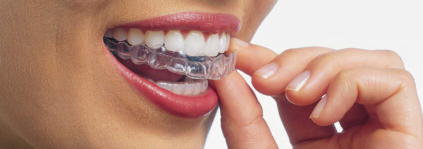 clear aligner