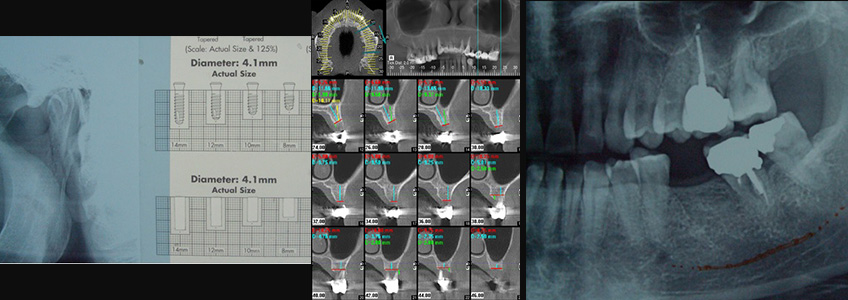 dental tomografi