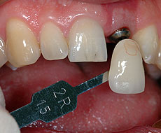 Dental implantlar