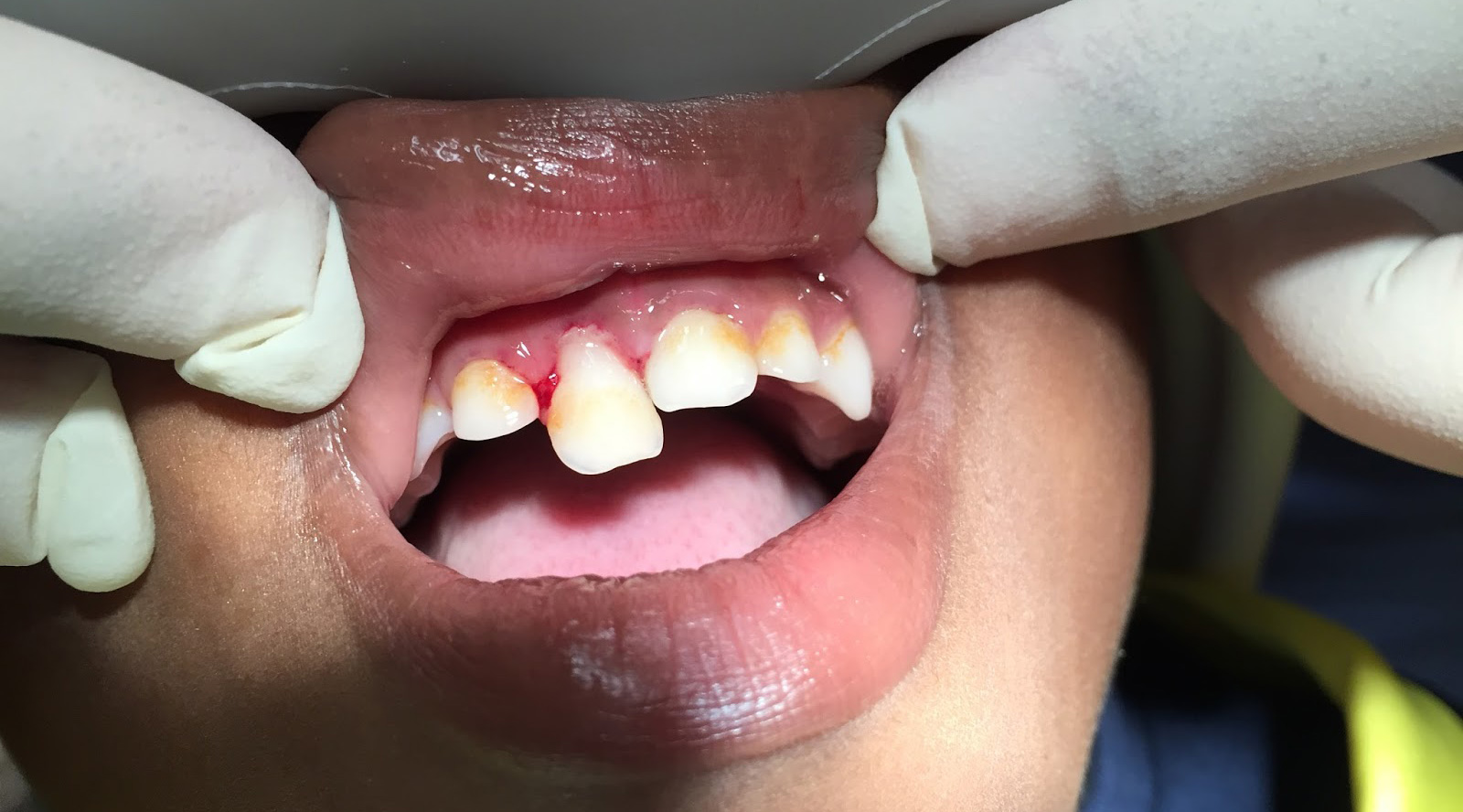 Diş Travmalarında Tedavi Seçenekleri