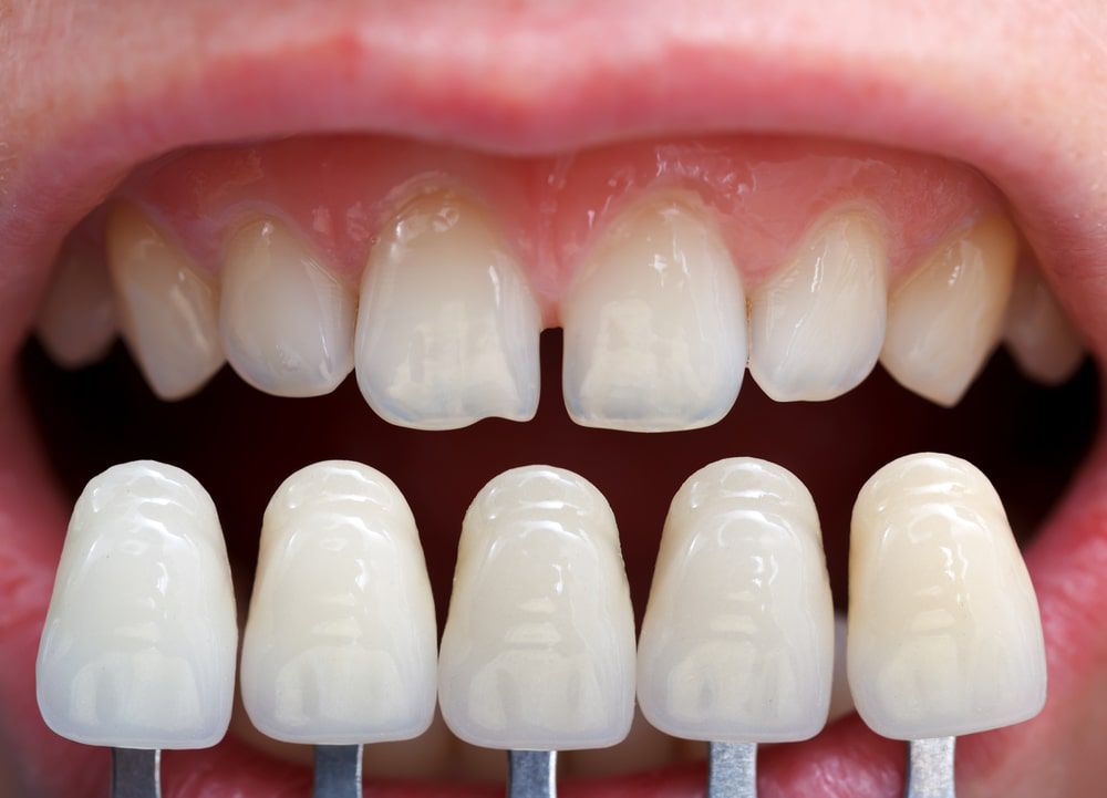 Konservatif ve Endodontik Tedaviler İle Gülüş Tasarımı