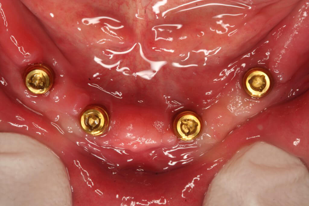 İmplant Destekli Hareketli Protezler