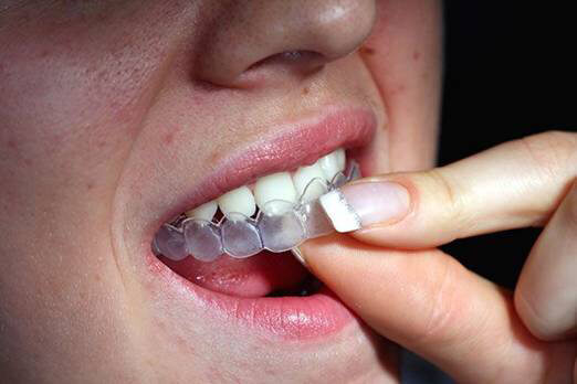 invisalign