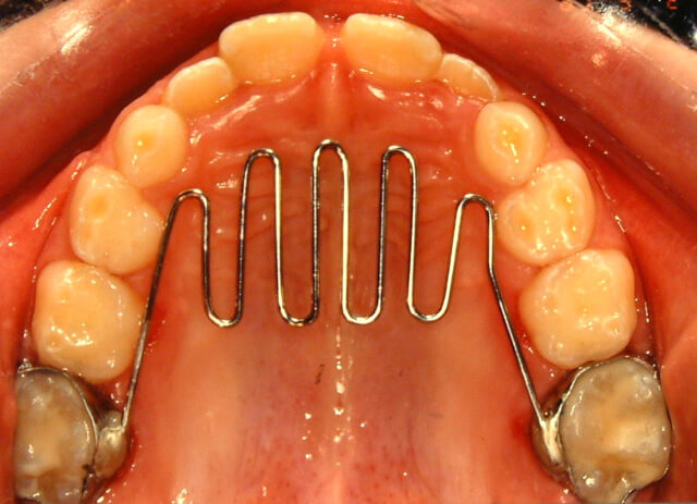 parmak-emme-nasil-engellenebilir