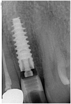 Tek Diş İmplantlar İçin Dişlerin Pozisyonlanması