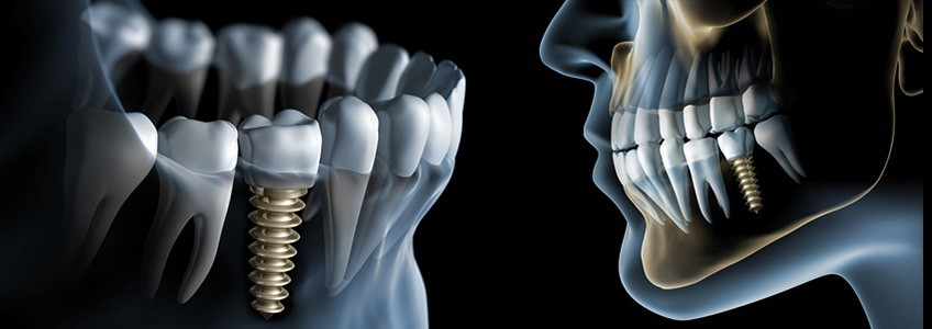 Tek Diş Eksikliklerinde Ortodontik Olarak İmplant Yerininin Hazırlanması