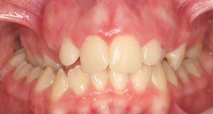 Açıklama: http://outstandingortho.com.s122702.gridserver.com/wp-content/uploads/2011/12/glossary_posterior-crossbite.jpg