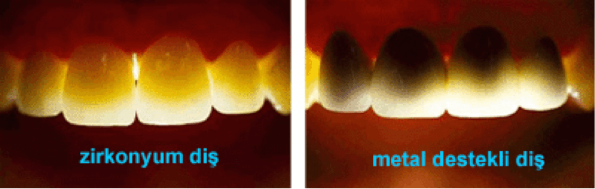 zirkonyom dişler