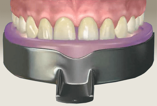 zirkonyum ölçü alınması